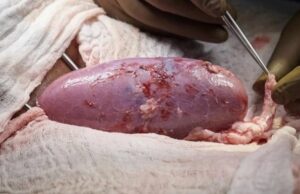 В США проведена первая успешная трансплантация свиной почки человеку