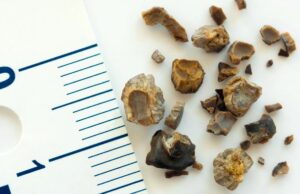 Новое звуковолновое устройство позволит разрушать камни в почках без операции