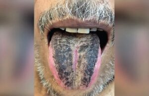 После перенесенного инсульта язык мужчины из Индии стал черным и мохнатым