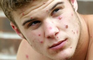 Почему текущей вспышки обезьяньей оспы не следует бояться