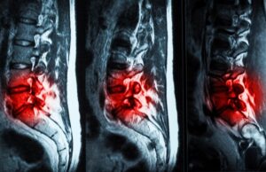 Инъекционный гидрогель эффективно избавит от болей в пояснице