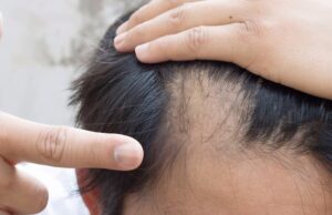 В США официально одобрили первое в своем роде лекарство от облысения