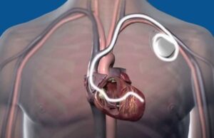 Кардиостимуляторы: виды, принцип работы. Где купить?