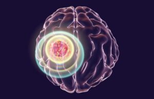 Инфракрасный имплант в черепе эффективно борется с раком мозга