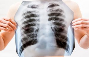 В «Сколтехе» обучили нейросеть обрабатывать рентген-снимки легких и ставить диагноз