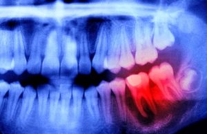 Японские ученые установили связь между здоровьем полости рта и мозга