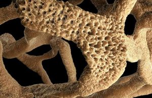 Российско-иранский препарат эффективно вылечит остеопороз