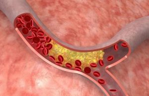 В Новосибирске создан полимер, предотвращающий разрывы сосудов