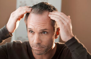 Выпадение волос удалось остановить с помощью новых микроигольчатых пластырей