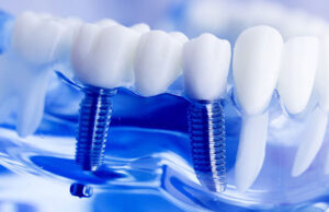 В Сеченовском университете начали внедрять новое поколение зубных имплантов