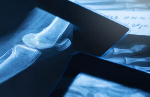 Токсичное биостекло убивает 99% раковых клеток без вреда для здоровых