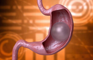 Управляемый воздушный шарик в желудке безвредно снижает количество съедаемой пищи на 60 %