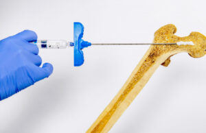 Инъекции костного геля помогут победить остеопороз