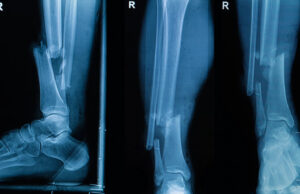 Клеевой пистолет позволит печатать заплатки для сломанных костей прямо во время операции