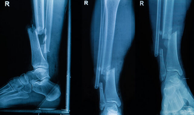 Клеевой пистолет позволит печатать заплатки для сломанных костей прямо во время операции