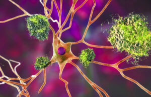 Белок-«виновник» Альцгеймера подзаряжает иммунные клетки и резко снижает риск рака
