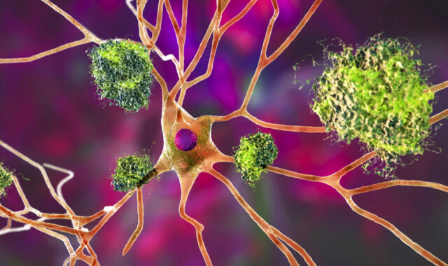 Белок-«виновник» Альцгеймера подзаряжает иммунные клетки и резко снижает риск рака