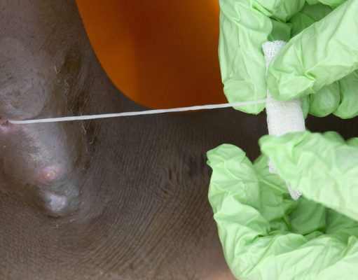 Человечество в шаге от полной победы над второй (после оспы) инфекционной болезнью в истории